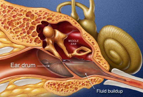 Middle Ear Infections