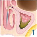 ENT Austin balloon sinuplasty 1