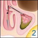 ENT Austin balloon sinuplasty 2