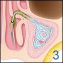 ENT Austin balloon sinuplasty 3