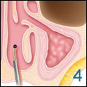 ENT Austin balloon sinuplasty 4