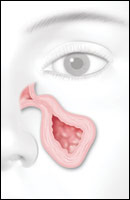 ENT Austin balloon sinuplasty - sinusitis