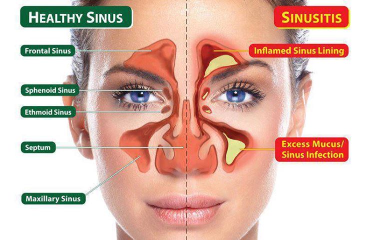 Image result for What to know about ethmoid sinusitis